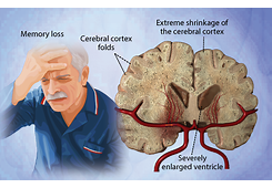 Illustration showing an elderly man with memory loss next to a brain cross-section highlighting cerebral cortex folds, extreme shrinkage, and severely enlarged ventricle due to dementia.