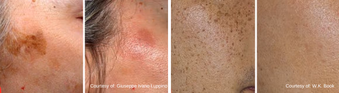 Before and after images showing reduction of dark sunspots and hyperpigmentation on facial skin.