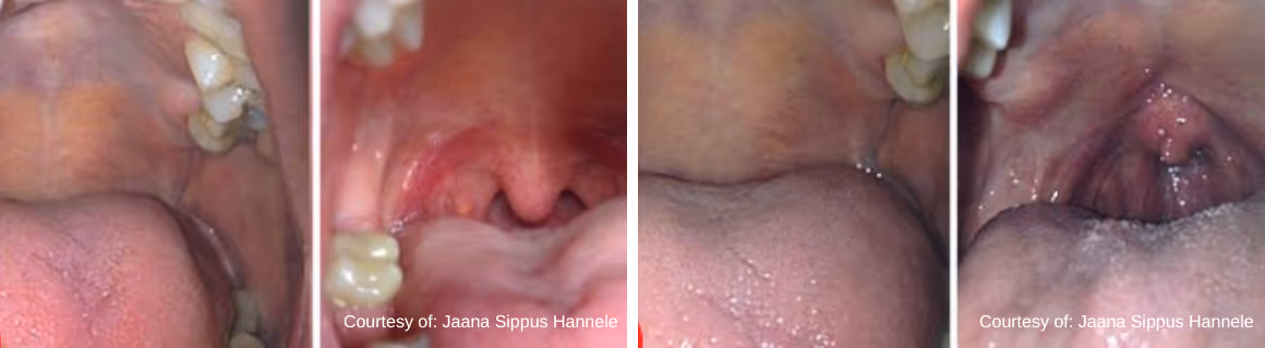 Comparison of two open mouths showing the tongue and throat area, focusing on the uvula and surrounding tissue before and after treatment.