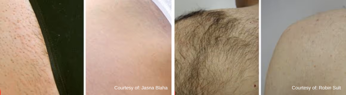 Side-by-side before and after images showing reduction of hair on the back of two individuals following hair removal treatment.