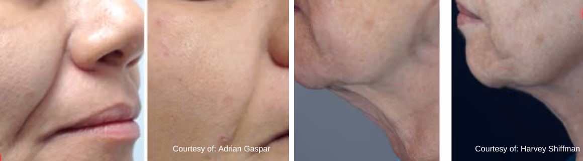Two side-by-side close-up comparisons of facial skin before and after treatment showing reduced wrinkles and smoother skin.