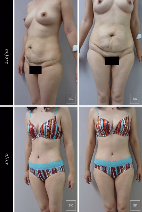 Before and After Tummy Tuck Photos - SK Plastic Surgery