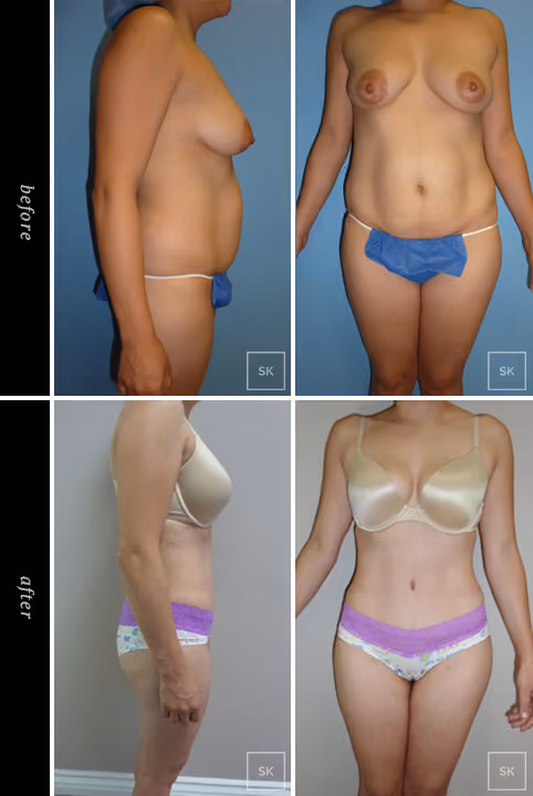 Before and After Tummy Tuck Photos - SK Plastic Surgery