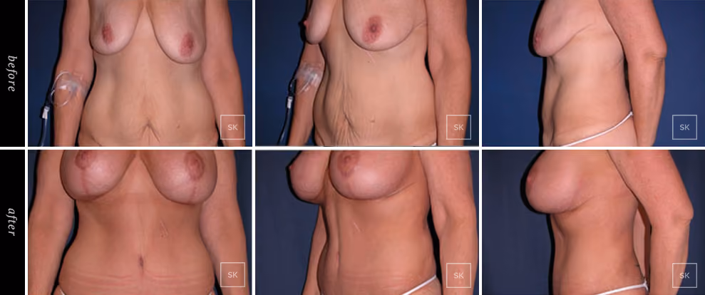 Before and After Body Lift Photos - SK Plastic Surgery