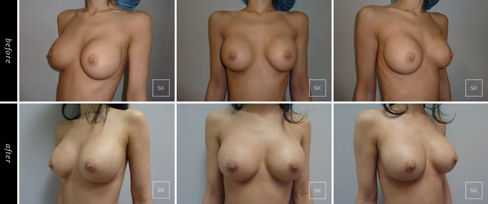 Before and After Breast Revision Photos - SK Plastic Surgery