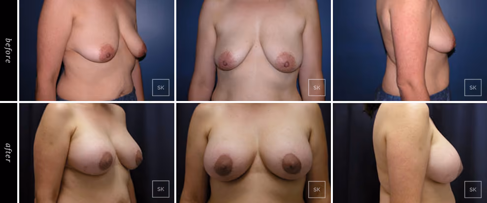 Before and After Breast Lift Photos - SK Plastic Surgery