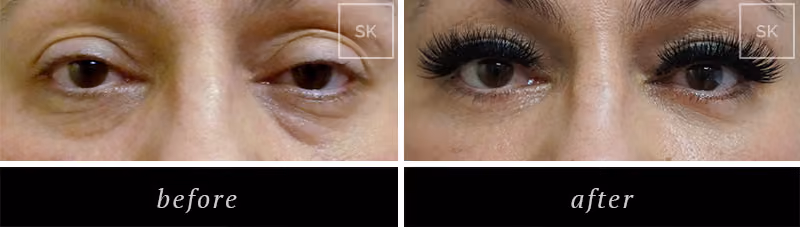 Before and After Eyelid Surgery, Asian Eyelid Surgery Photos - SK Plastic Surgery