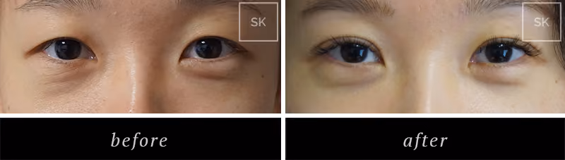 Before and After Eyelid Surgery, Asian Eyelid Surgery Photos - SK Plastic Surgery