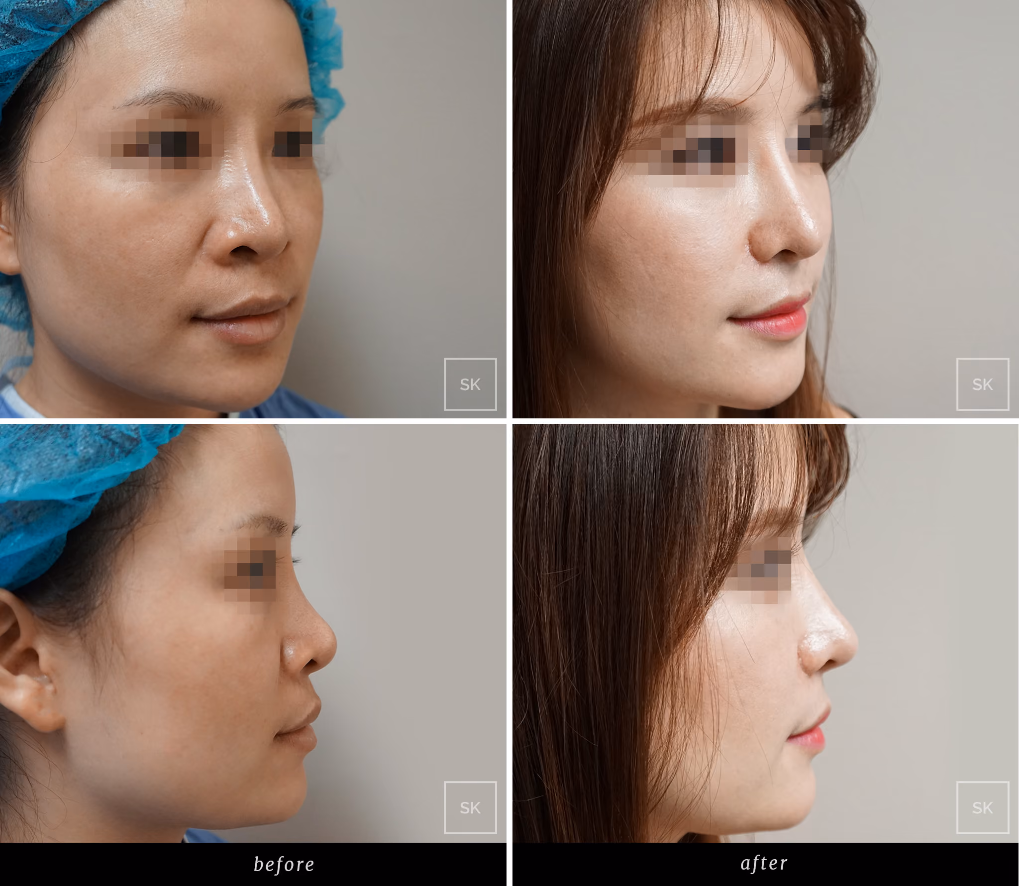 Before and After Nose Surgery Photos - SK Plastic Surgery