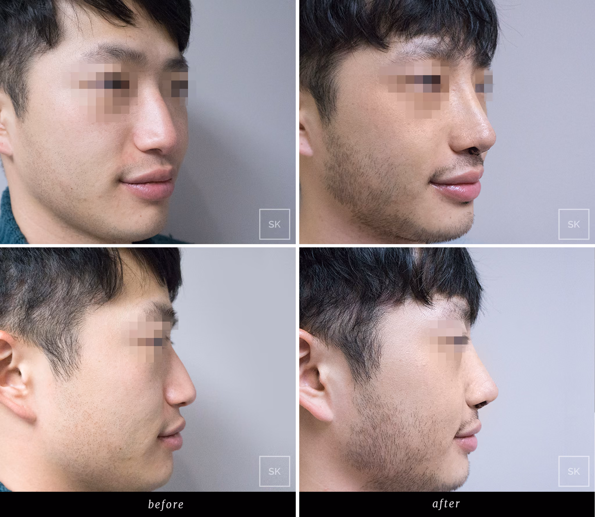 Before and After Nose Surgery Photos - SK Plastic Surgery