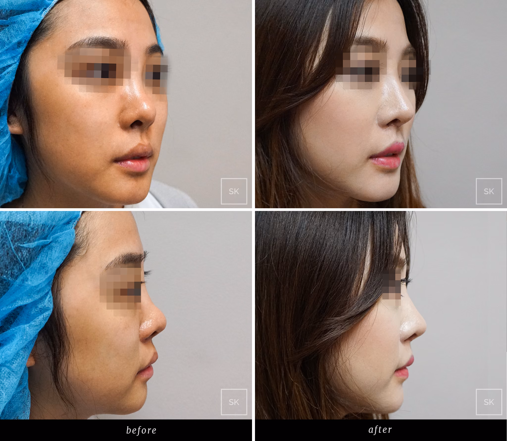 Before and After Nose Surgery Photos - SK Plastic Surgery