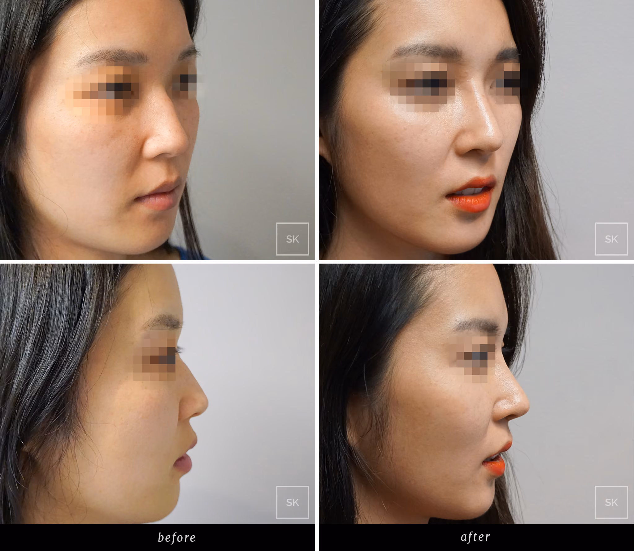 Before and After Nose Surgery Photos - SK Plastic Surgery