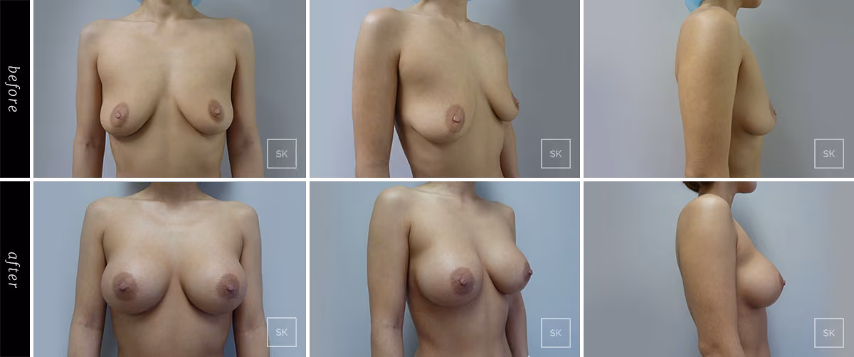 Before and After Breast Augmentation Photos - SK Plastic Surgery