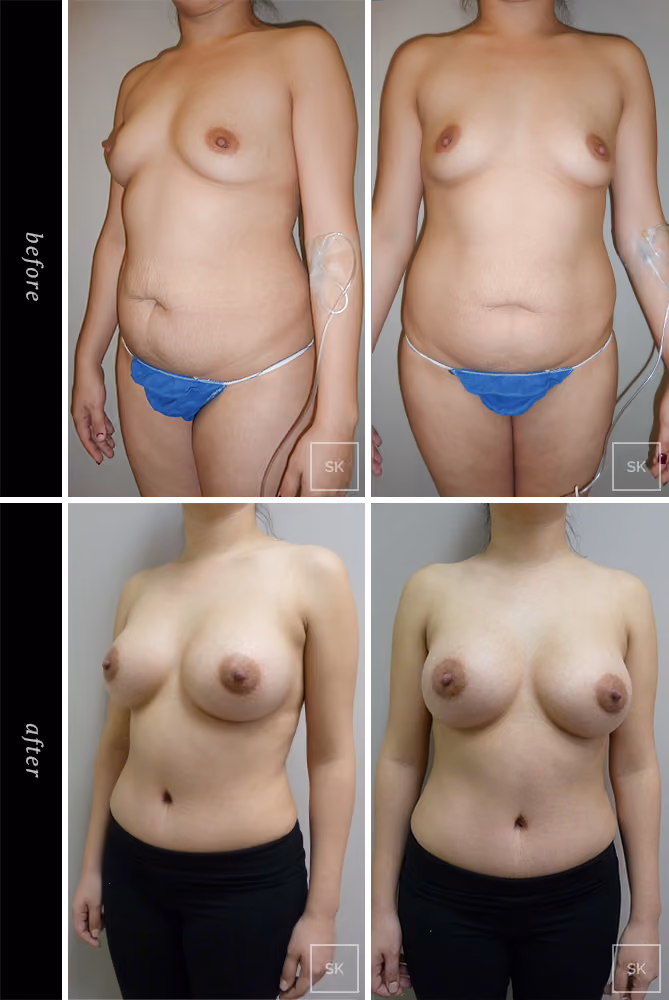 Before and After Tummy Tuck Photos - SK Plastic Surgery