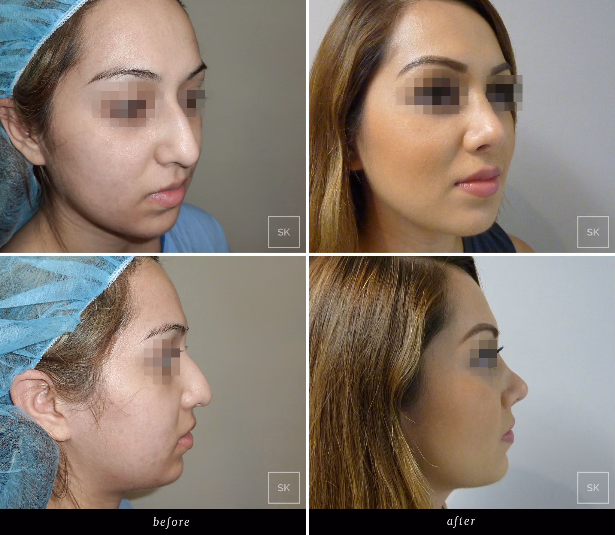 Before and After Nose Surgery Photos - SK Plastic Surgery