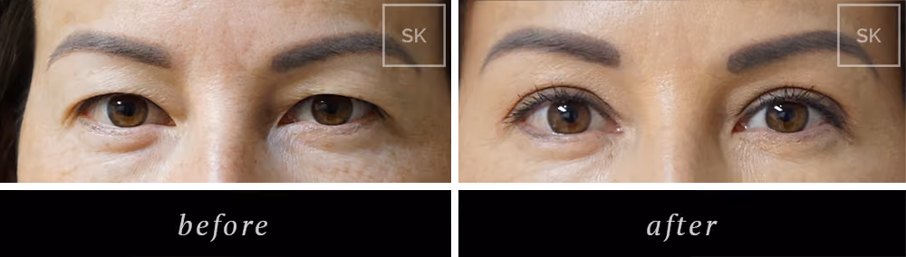 Before and After Eyelid Surgery, Asian Eyelid Surgery Photos - SK Plastic Surgery