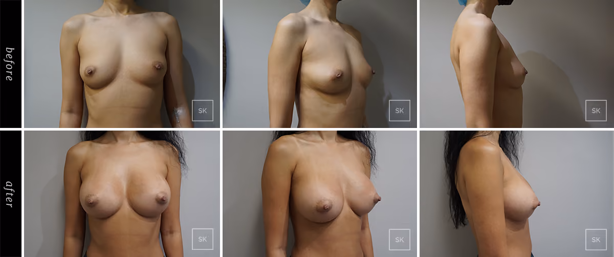 Before and After Breast Augmentation Photos - SK Plastic Surgery