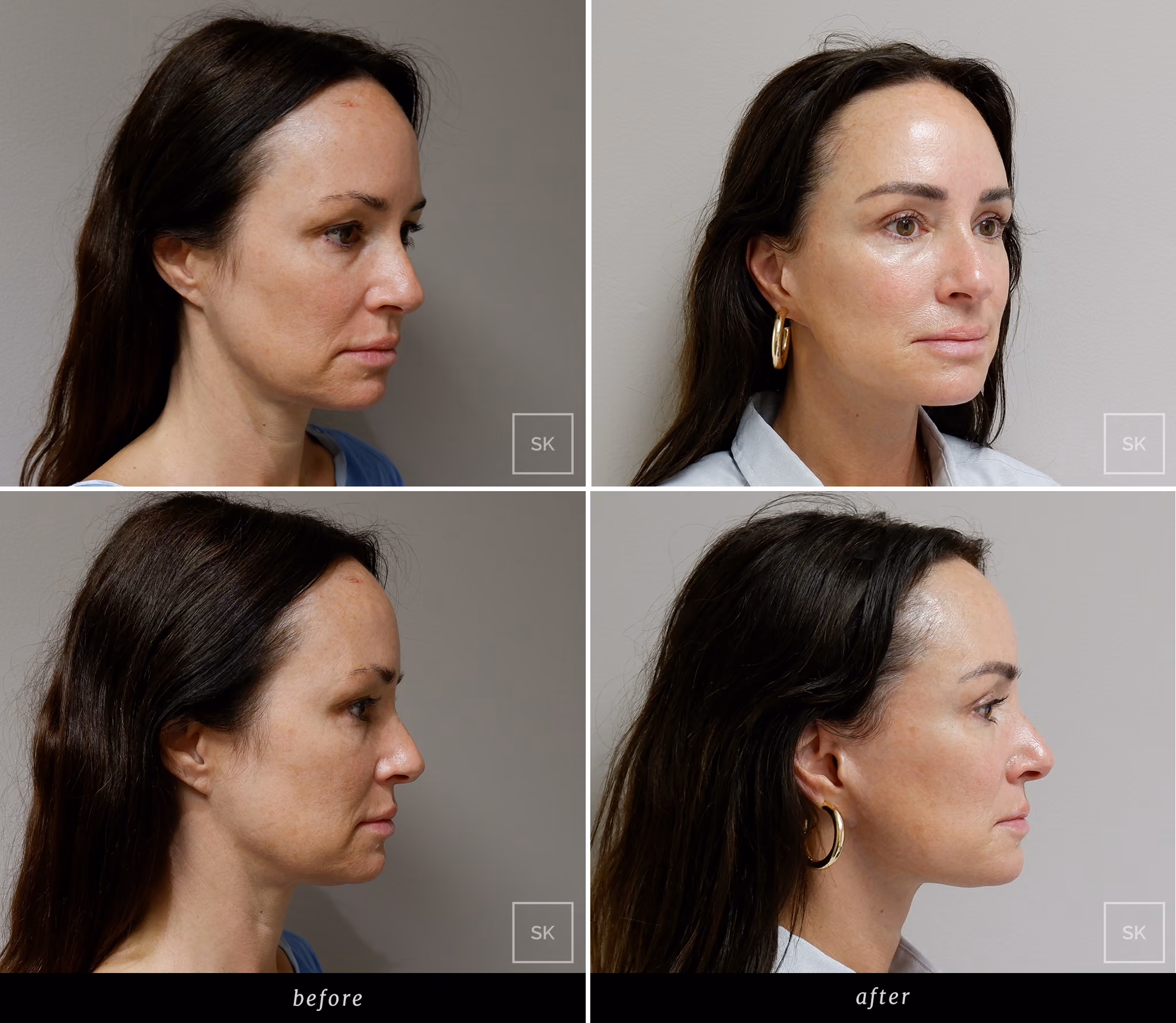 Before and After Face Lift - SK Plastic Surgery