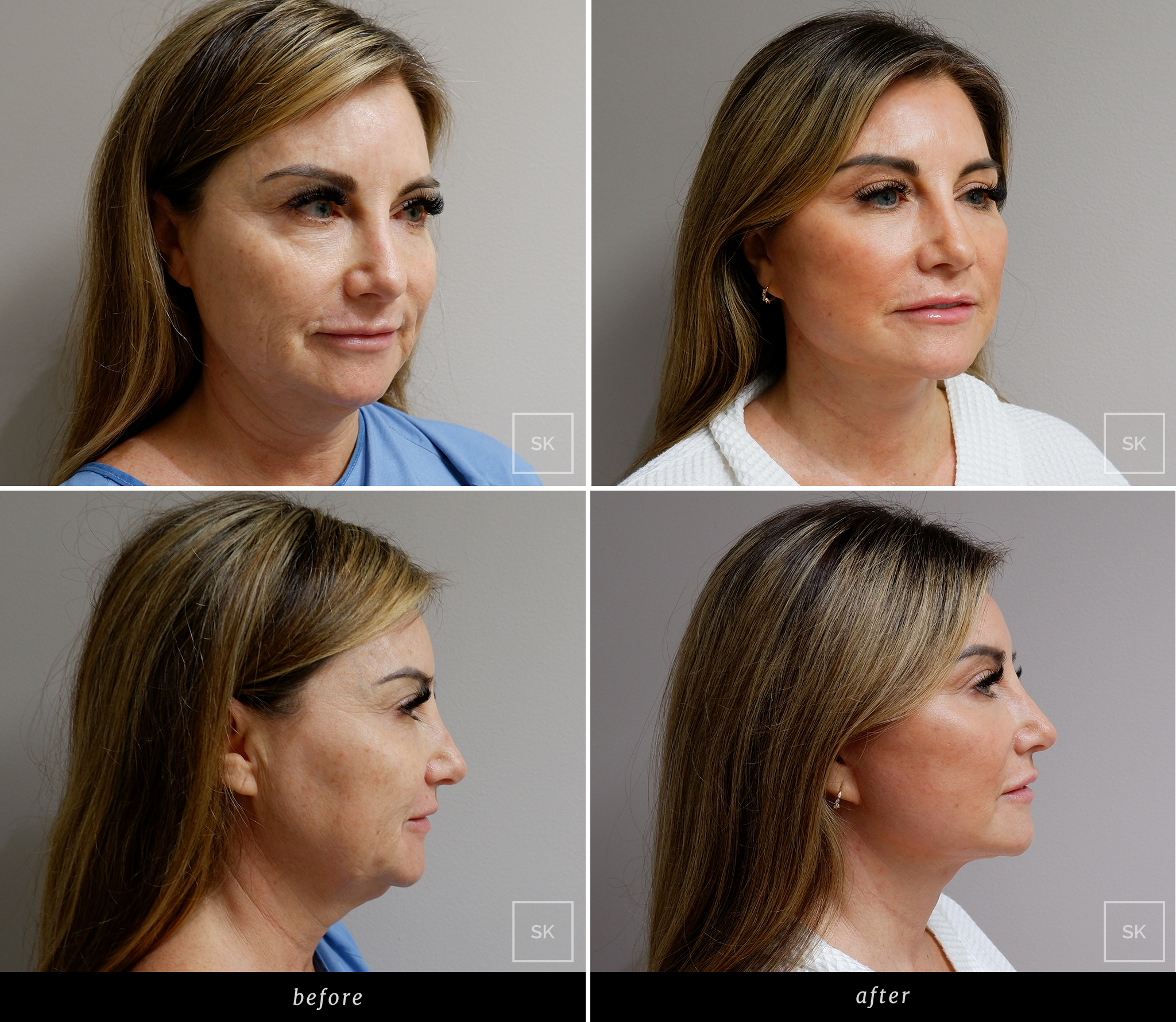 Before and After Face Lift - SK Plastic Surgery