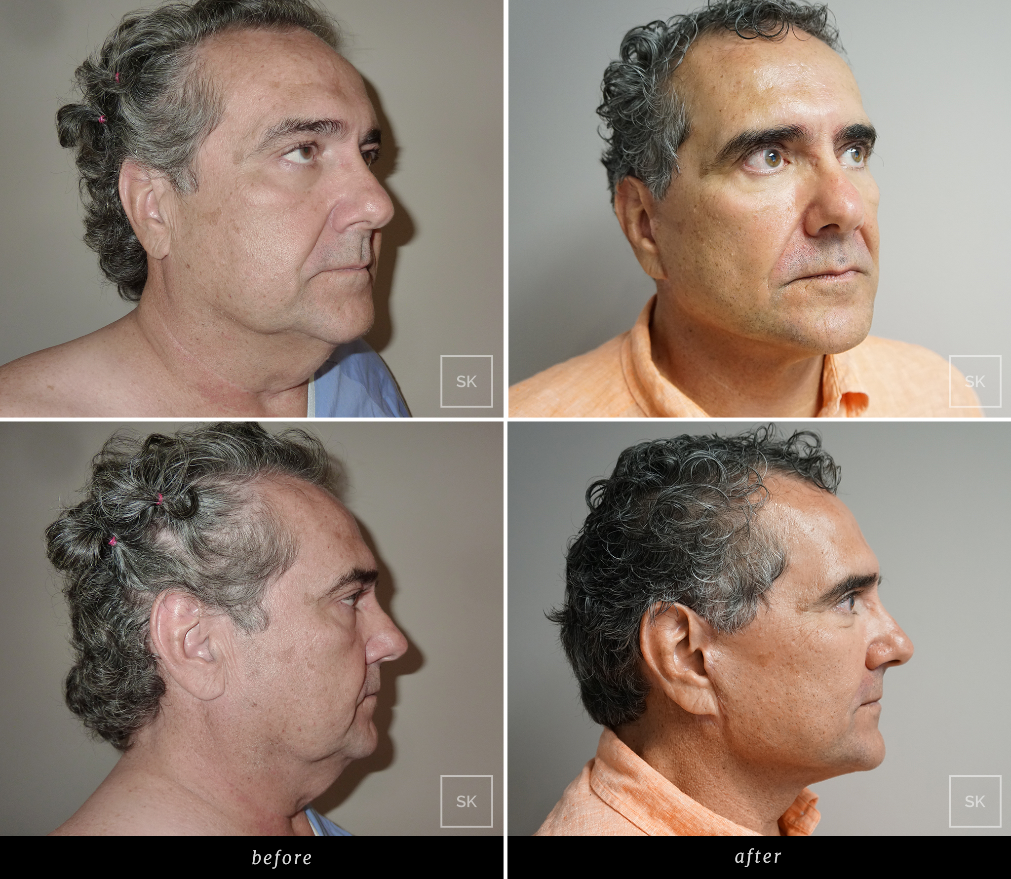 Before and After Face Lift - SK Plastic Surgery