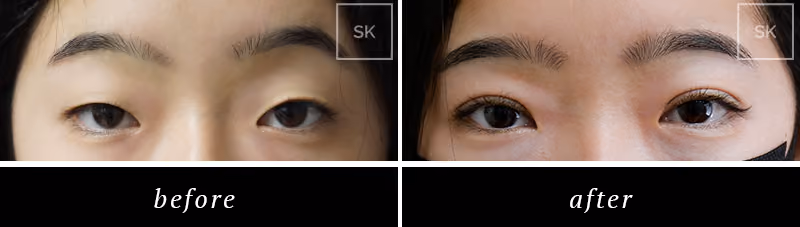 Before and After Eyelid Surgery, Asian Eyelid Surgery Photos - SK Plastic Surgery