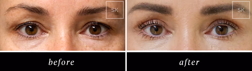Before and After Eyelid Surgery, Asian Eyelid Surgery Photos - SK Plastic Surgery