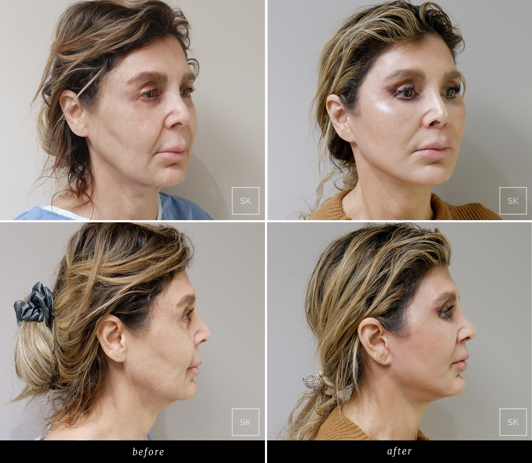 Before and After Face Lift - SK Plastic Surgery