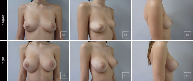 Before and After Breast Augmentation Photos - SK Plastic Surgery