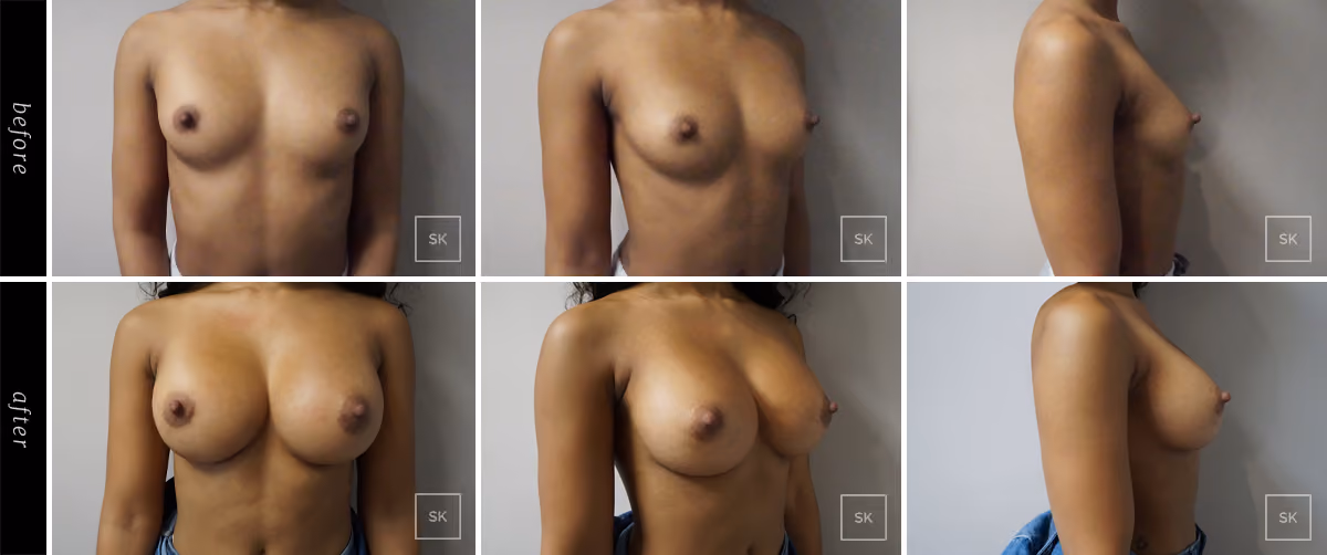 Before and After Breast Augmentation Photos - SK Plastic Surgery
