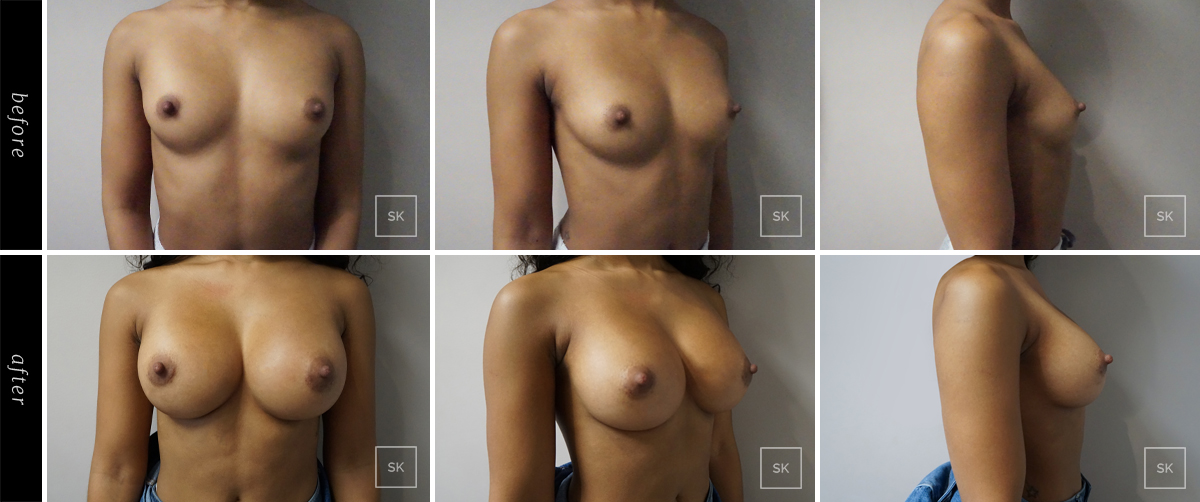Before and After Breast Augmentation Photos - SK Plastic Surgery