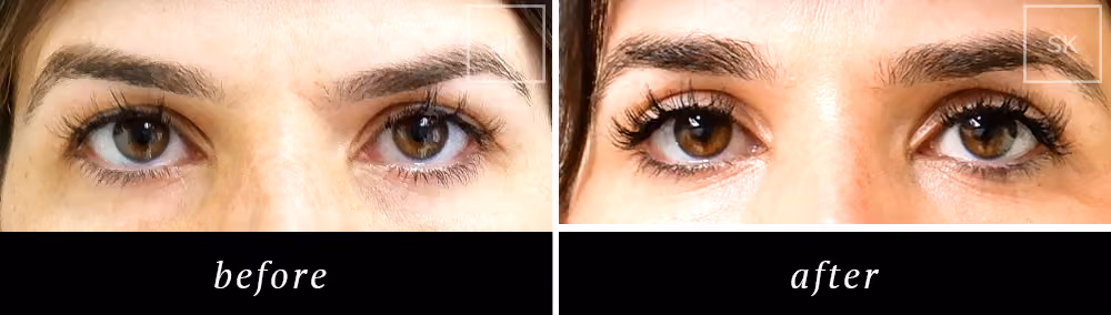 Before and After Eyelid Surgery, Asian Eyelid Surgery Photos - SK Plastic Surgery