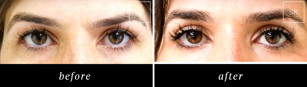 Before and After Eyelid Surgery, Asian Eyelid Surgery Photos - SK Plastic Surgery