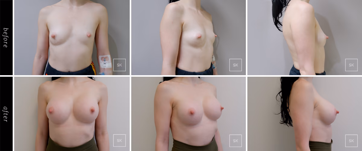 Before and After Breast Augmentation Photos - SK Plastic Surgery