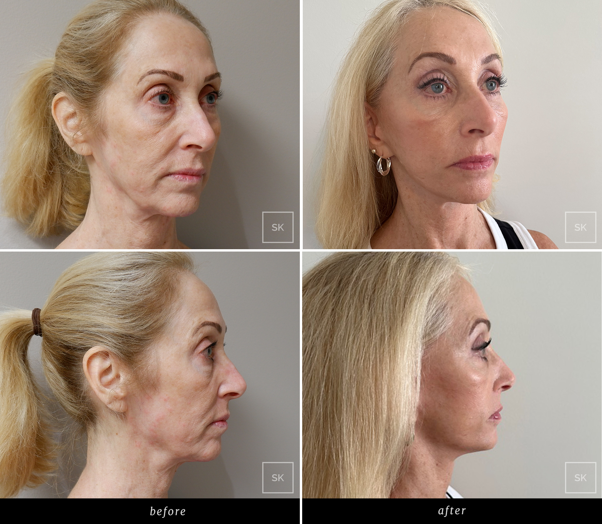 Before and After Face Lift - SK Plastic Surgery