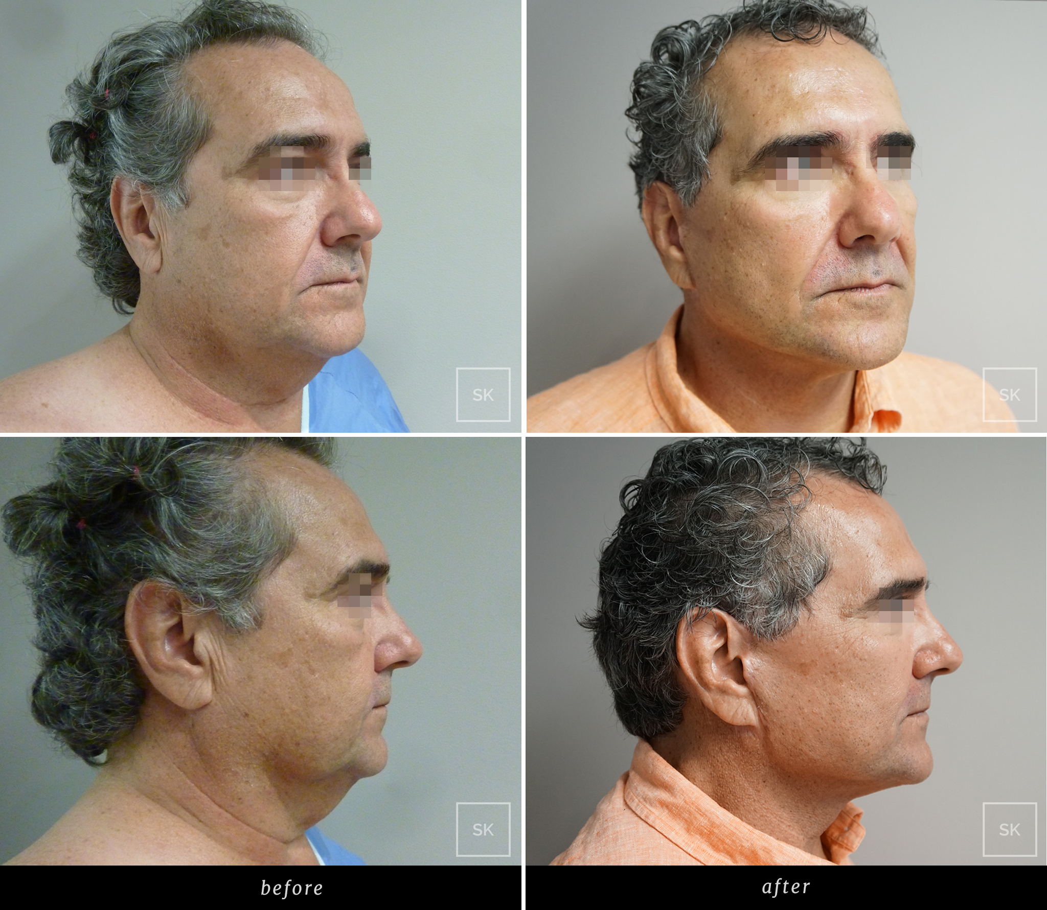Before and After Face Lift - SK Plastic Surgery
