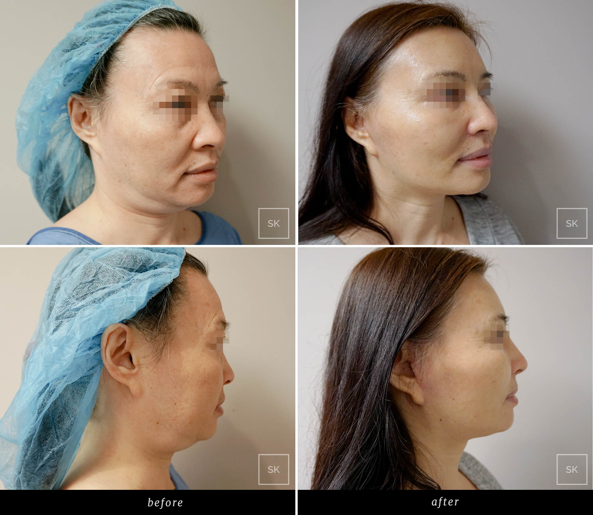 Before and After Face Lift - SK Plastic Surgery