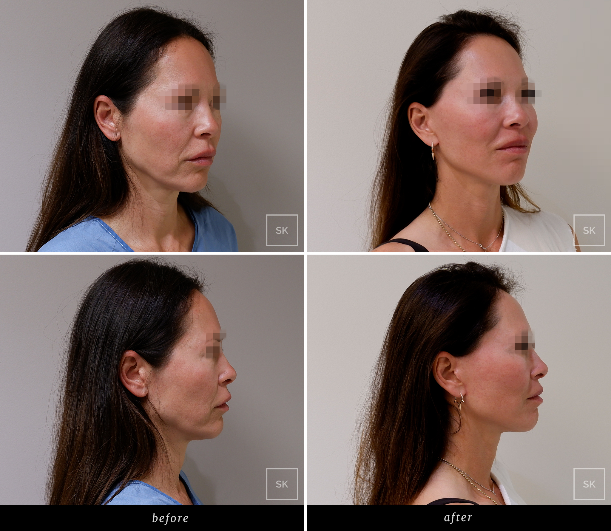 Before and After Face Lift - SK Plastic Surgery