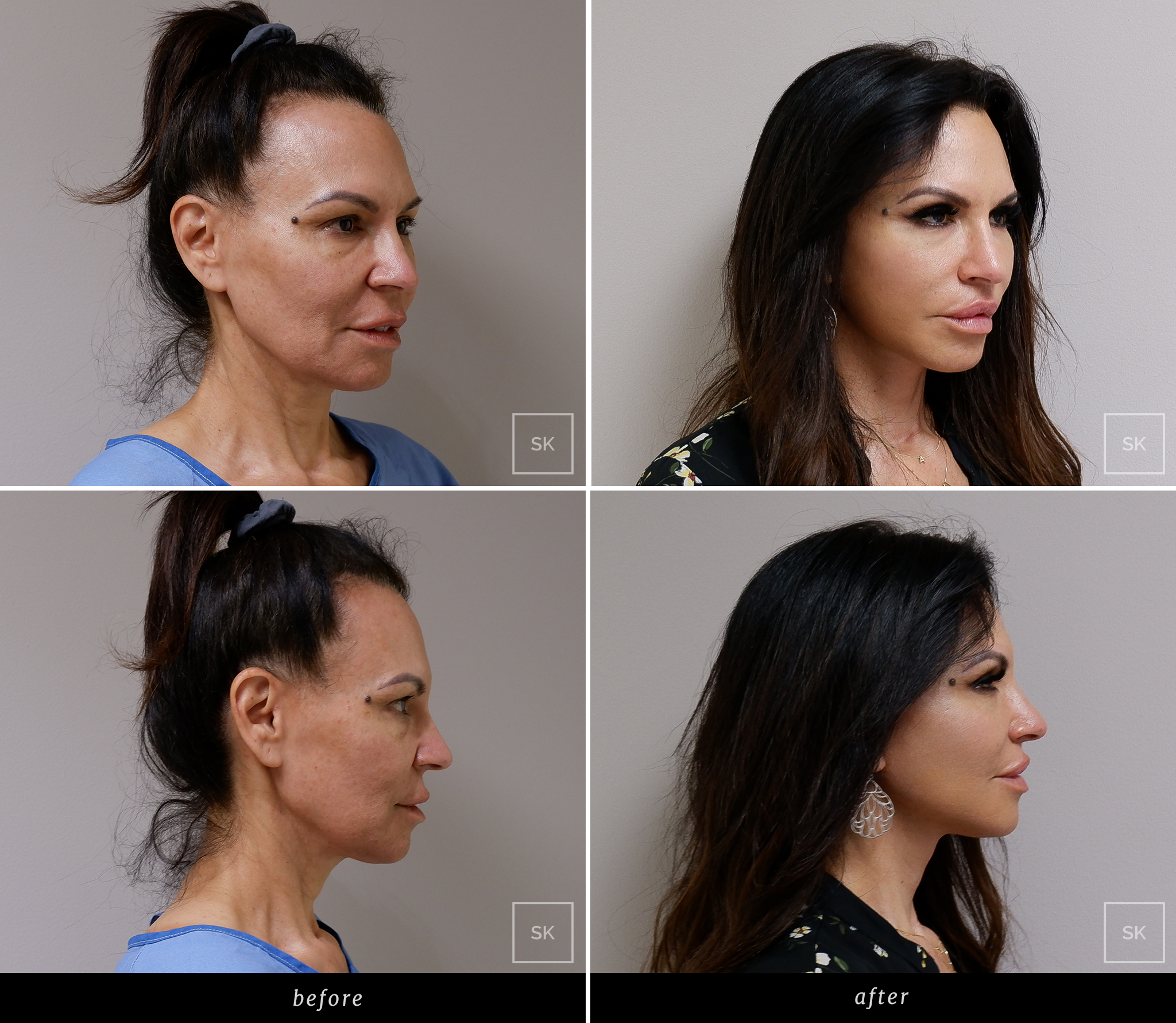 Before and After Face Lift - SK Plastic Surgery