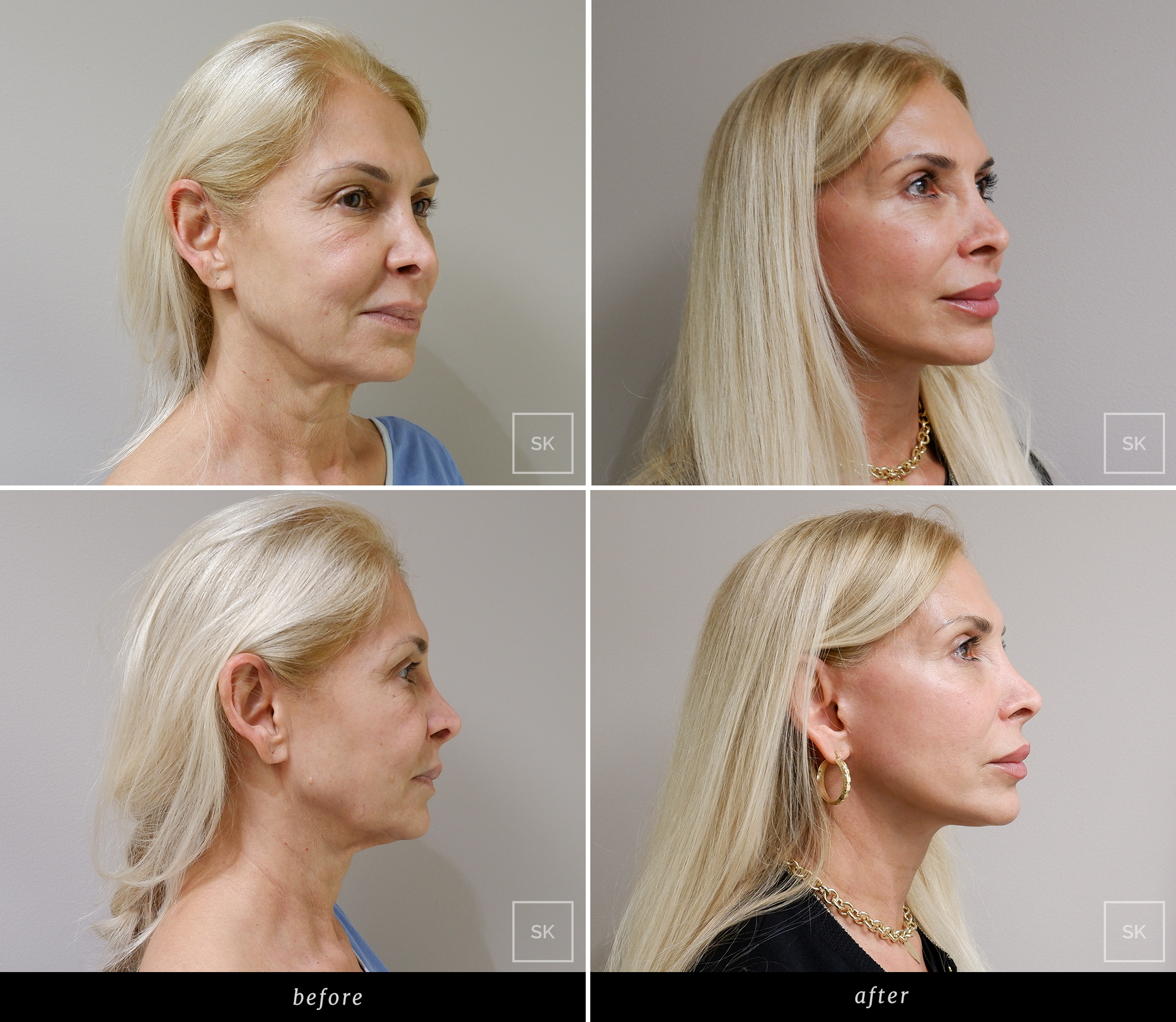 Before & After Photo Gallery