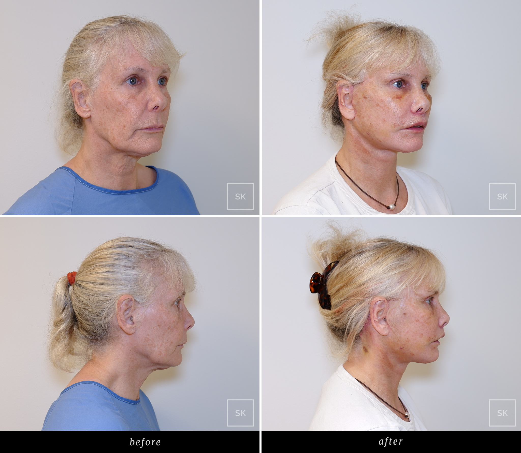 Before & After Photo Gallery