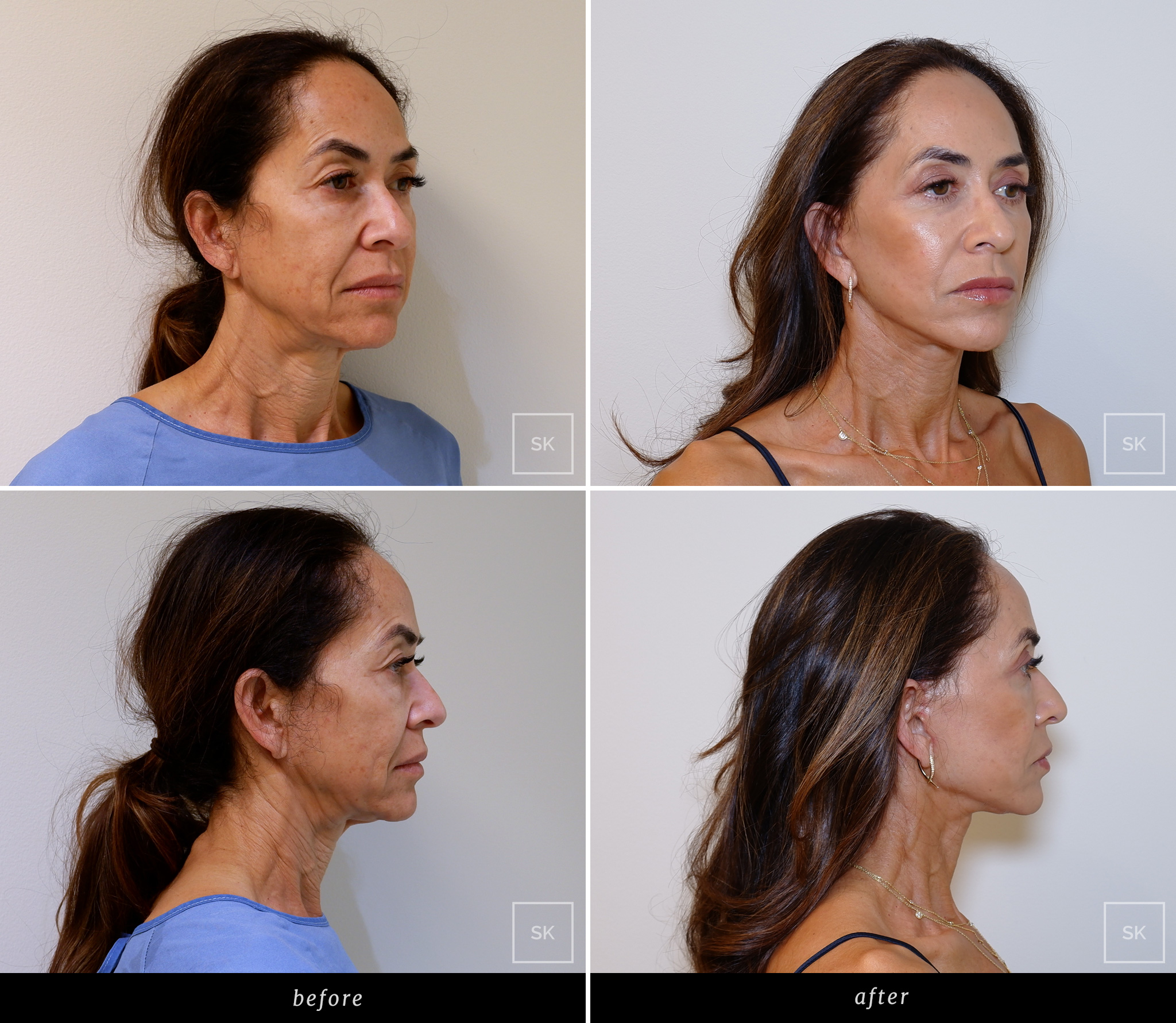 Before & After Photo Gallery