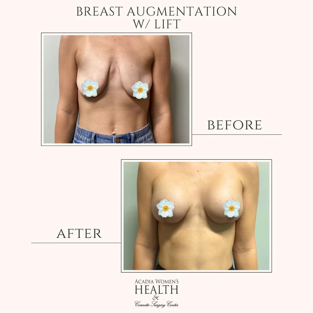Breast lift before and after results in Crowley, LA