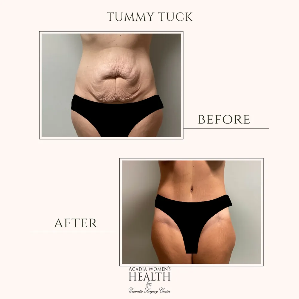 Tummy tuck before and after results in Crowley, LA