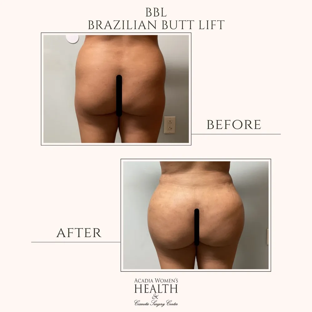 Brazilian butt lift before and after results in Crowley, LA