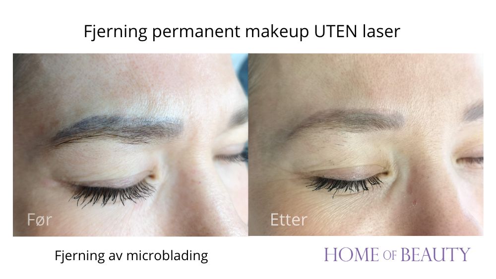 Kan man fjerne gammel permanent makeup på lepper