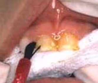 fluoride varnish