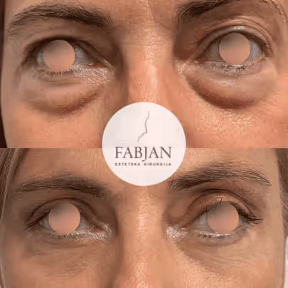 Blepharoplastik vor der Augenlidoperation von Matic Fabjan
