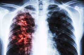 Angola entre os países com mais casos de tuberculose no mundo
