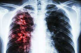 Angola entre os países com mais casos de tuberculose no mundo