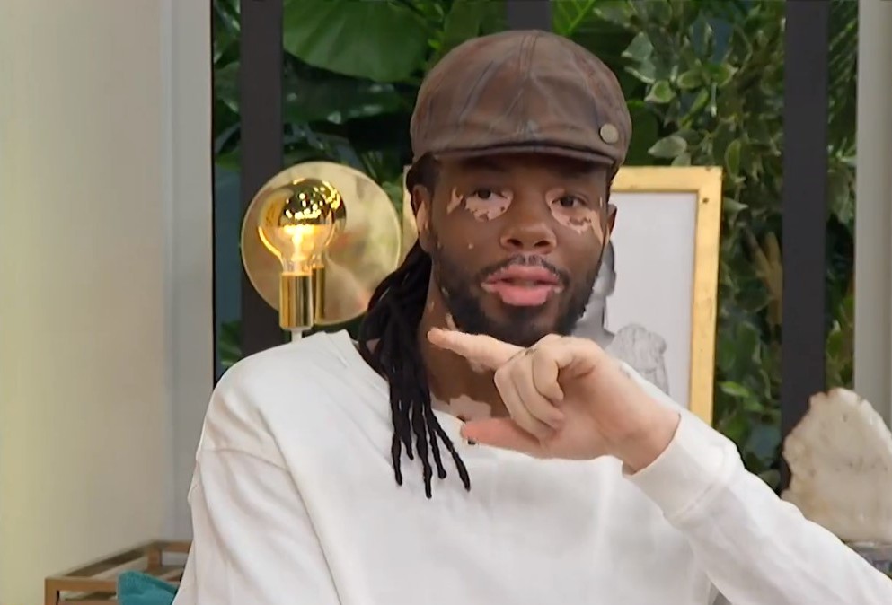 Wilmar Nakeni considera que “dizer que não existe cura para o vitiligo é um erro”